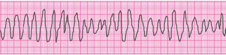 ventricular-tachycardia-torsades-de-pointes