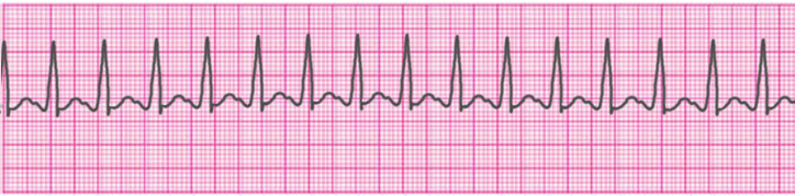 PALS Bradycardia Algorithm - ACLS Medical Training